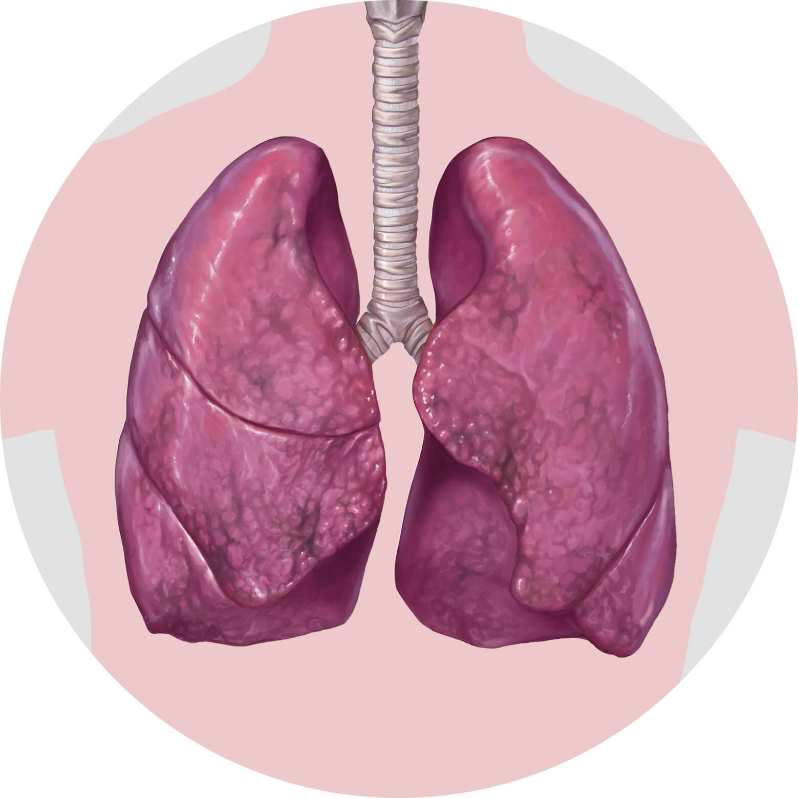 Lungs with ILD Scarring